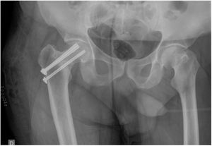 Osteosíntesis de fractura con tornillos canulados.
