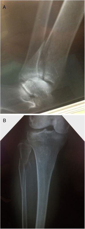 A & B: Volkmann and Maisonneuve fractures.