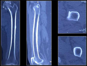 Tomografía de fémur izquierdo. Se visualiza cortical ósea continua, osteófitos marginales en cóndilo medial y lateral.