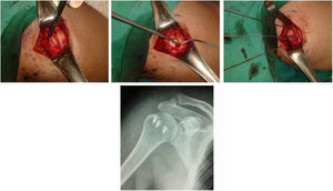Tenorrafia del supraespinoso con sutura arponada de titanio en hombro derecho. Archivo fotográfico y radiológico del Hospital Alcívar.