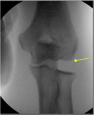 Radiografía con stress en varo del codo izquierdo: Aumento de espacio articular humero radial. Archivo del Dpto. de Imágenes Hospital Alcívar.