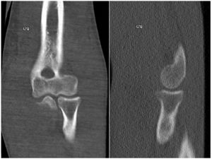 TAC de codo izquierdo: No se observan alteraciones de las estructuras óseas. Archivo del Dpto. de Imágenes Hospital Alcívar.