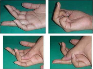 Examen físico de tendones superficial y profundo de dedo anular de mano derecha. Archivo fotográfico Hospital Alcívar.