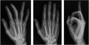 Proyecciones radiográficas en mano derecha no se observa lesión osea. Archivo del Dpto. de Imágenes Hospital Alcívar.