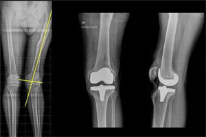Cortes inusuales intraarticulares y artroplastia total de la rodilla izquierda.