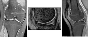 Resonancia magnética de rodilla derecha en la que no se evidencian alteraciones. Fuente: Archivos médicos Hospital Alcivar.