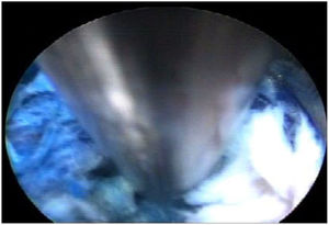 Visualización de la pinza por medio del endoscopio. Realice la discectomía manual con pinza sacabocados endoscópica, retirando la mayor cantidad de disco posible marcado previamente. 32–36 (figura 18).