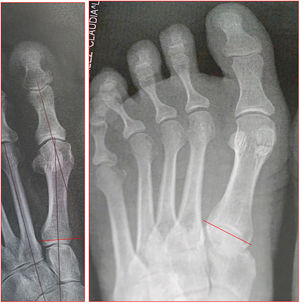 Articulación tarso inclinada.