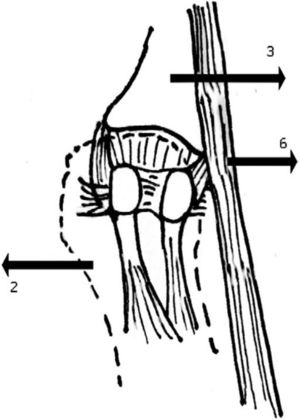 Se pierde la congruencia articular de los sesamoideos con la parte plantar de la cabeza del primer metatarsiano.