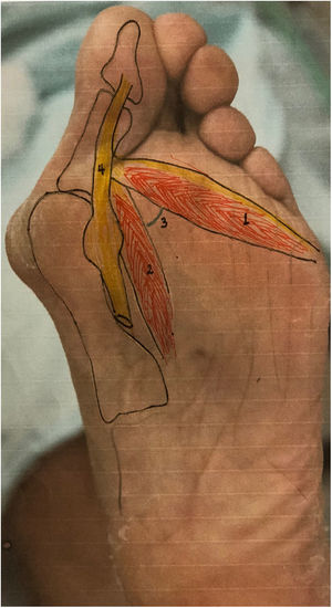 Vista plantar: 1. Porción transversa aductor hallux 2. Porción oblicua aductor hallux 3. Angulo 4.Flexor hallucis longus.