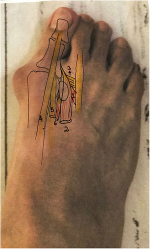 Vista dorsal: 1. Porción transversa del aductor hallux 2. Porción oblicua del aductor hallux 3. Ligamento trasverso profundo intermetatarsiano 4. Extensor hallucis longus 5. Extensor hallucis brevis 6. Porción lateral del flexor hallucis brevis.