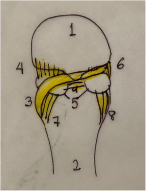 1. Cabeza primer metatarsiano 2. Falange proximal 3. Menisco 4. Ligamento lateral metatarso s sesamoideo 5. Sesamoideos 6. Ligamento medial metatarsosesamoideo 7. Ligamento lateral falange sesamoideo 8. Ligamento medial falange sesamoideo 9. Ligamento intersesamoideo.