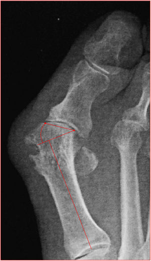 Reposición de la falange.