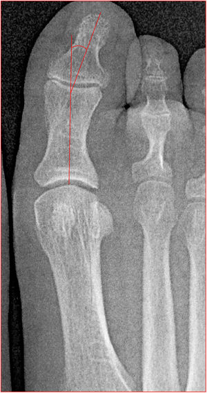 Angulo de valgo interfalángico Figura 7. Angulo intermetatarsiano.