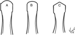 Distintas morfologías de la cabeza del primer metatarso: A. Cabeza esférica, B. Cabeza aplanada, C. Cabeza tipo Chevron.