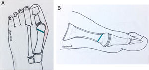 Orientación de la Osteotomía de Bösch: en el plano Coronal (A) y en el plano Sagital (B).