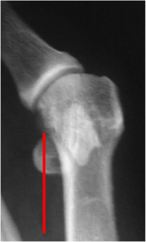 Foto 7: Clasificación The American Orthopedic Foot Society de la ubicación de los sesamoideos Grado II: ubicación mayor del 50% del sesamoideo medial hacia lateral, con relación a la línea media de la cabeza.