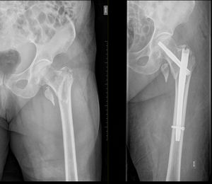 a la izquierda radiografía preoperatoria que muestra fractura pertrocanterea de fémur izquierdo, a la derecha control posoperatorio inmediato que muestra síntesis con clavo endomedular.