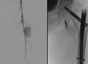 a la izquierda se observa imagen de un pseudoaneurisma de la arteria femoral profunda, a la derecha, control posoperatorio inmediato a su embolización.