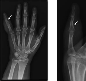 Radiografía simple de mano AP y lateral donde se evidencia aumento del volumen de tejidos blandos (flecha blanca). No se evidencia reacción perióstica.