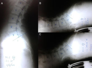 Radiografías simples de perfil y mediciones. (A) de pie; (B) en posición baja de SCE y (C) en posición alta de SCE.