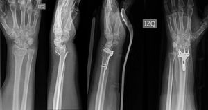 Fractura extra articular. La imagen muestra los Rx prequirúrgicos y postquirúrgicos de un paciente con fractura inestable de radio distal, con conminución dorsal, tipo A del brazo izquierdo que hizo parte del grupo de fracturas extra articulares.