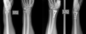 Fractura intra articular. La imagen muestra los Rx prequirúrgicos y postquirúrgicos de un paciente con fractura inestable de radio distal, trazo articular, desplazamiento parcial, tipo B del brazo izquierdo que hizo parte del grupo de fracturas intra articulares.