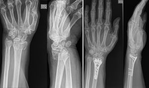 Fractura intra articular. La imagen muestra los Rx prequirúrgicos y postquirúrgicos de un paciente con fractura inestable de radio distal, intra articular, desplazada, conminuta, tipo C del brazo izquierdo que hizo parte del grupo de fracturas intra articulares.