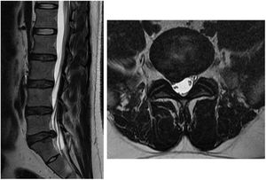 Resonancia magnética (secuencia T2) de un paciente masculino de 39 años con síntomas de dolor irradiado en miembro inferior derecho. Se observa una hernia discal central extruida en el nivel L5-S1.