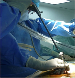 Ingreso del endoscopio a través del abordaje interlaminar.