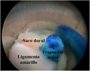 Vista endoscópica del fragmento discal por vía interlaminar.