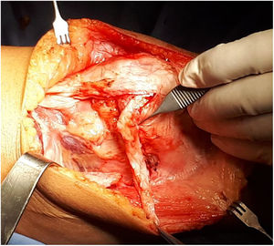 Plegado y sutura de injerto. La foto muestra el injerto plegado sobre sí mismo y luego suturado sobre el periostio medial rotuliano.