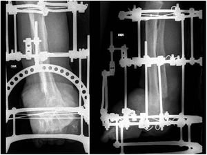 En control imagenológico postquirúrgico inmediato, que se parecía en Figura 6, se puede apreciar: fijación en tibia retro-medio/pie, osteotomía en pilón tibial y en fíbula hacia sus porciones distales, obteniendo pie plantígrado.