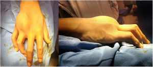 Fotografías clínicas de la mano, donde se observa la tumoración en región dorsal.