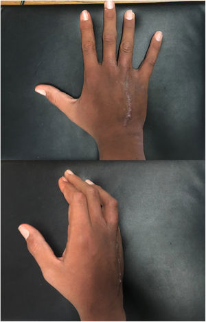 Fotografías clínicas de la mano, con adecuada cicatrización de la herida.