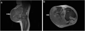 Resonancia magnética nuclear de muslo, evidencia masa en tejidos blandos (flecha blanca). 1A Coronal T1, 1B Axial T1.