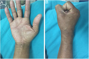 A, B. Se observa una cicatríz normal, sin cambios tróficos, y una movilidad completa de los dedos.