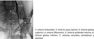 Arteriografía de la arteria iliaca interna y sus ramas.