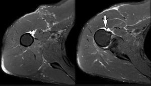 Diagnóstico de imágenes de resonancia magnética. Los cortes preoperatorios de RM axiales debajo del músculo subescapular muestran un desgarro completo del tendón pectoral mayor del hombro derecho en el punto de inserción ósea (flecha).