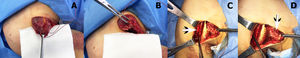 Imagenes quirurgicas. Las imágenes A y B representan un enfoque axilar deltopectoral y una fácil identificación del tendón del músculo pectoral mayor desgarrado. Se colocan suturas de reposo y se utiliza la técnica de sutura de Krackow para reparar el tendón. La imagen C muestra la inserción humeral exacta del tendón pectoral mayor desgarrado y el lugar donde se ubicaron los anclajes GII durante la reinserción del tendón (flecha). La imagen D muestra las suturas de Krackow listas para ser atadas a la inserción humeral del tendón pectoral mayor (flecha).