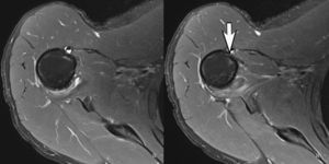 Seis meses después de la RM. Los cortes axiales de RM debajo del músculo subescapular muestran una curación completa del tendón pectoral mayor con la brecha de ruptura completa cerrada (flecha).