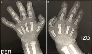 Radiografías AP de las manos. a. Las estructuras óseas de la mano derecha son normales. b. Ausencia del tercer rayo (tercer metacarpiano y falanges).