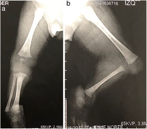 Radiografía lateral de extremidades inferiores; a. Las estructuras óseas del miembro inferior derecho son normales; b. Ausencia completa de la tibia izquierda con ensanchamiento del peroné, especialmente de la metáfisis distal.