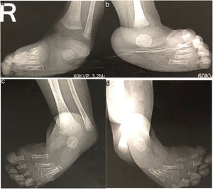 Radiografía oblicua de pies. Extremidad derecha (a,c); izquierda (b,d). Pie equino varo aducto bilateral.
