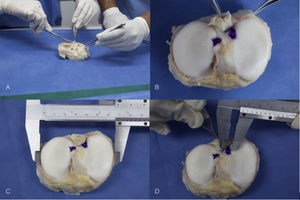 Disección y medición de los especímenes En la imagen A se muestra la disección del platillo con resección de los meniscos. En la imagen B se marcan las huellas de la inserción del cuerno posterior del menisco medial. Adicionalmente se mide el tamaño del platillo tibial (C) y se realiza la medición de la huella (D).