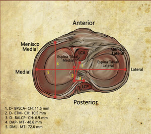 La Figura 2 demuestra en la vista superior de la meseta tibial la relación de la huella del cuerno posterior del menisco medial con las estructuras intraarticulares de la rodilla (LCA, ligamento cruzado anterior; LCP, ligamento cruzado posterior; Espina tibial medial).