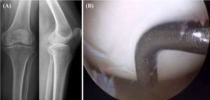 Ejemplo de una radiografía (A) y una imagen de artroscopia (B) presentadas a los observadores.