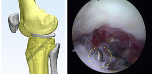 Esquema de túnel transtibial y fotografía de perforación en la base de la raíz meniscal.