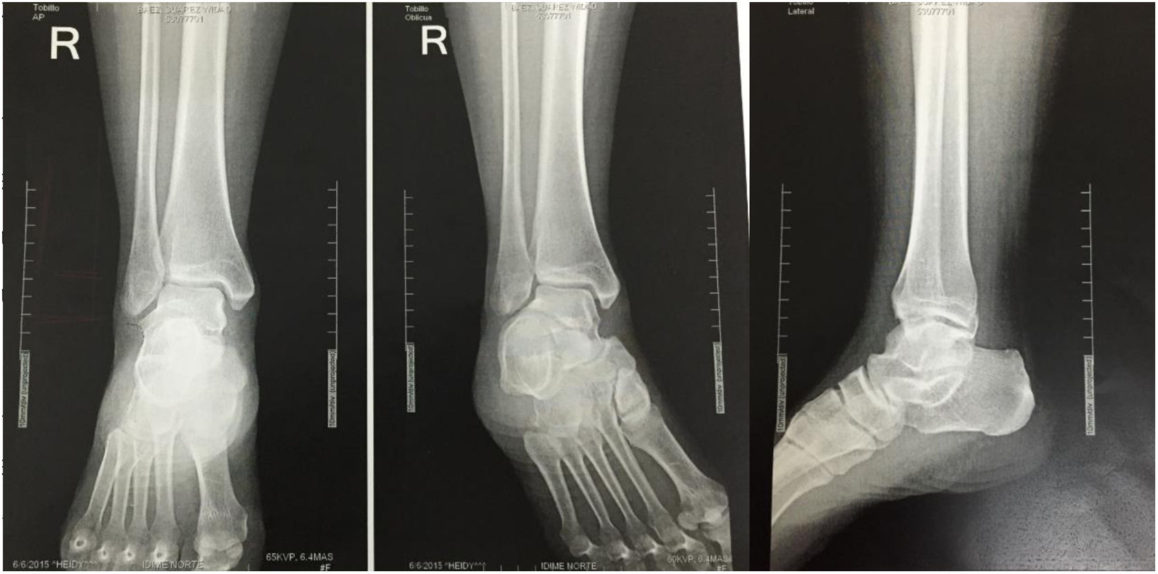 Tobillo Rx Evaluación Objetiva de las Radiografías de Tobillo como Patrón de Oro ...