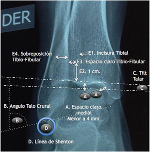 Medidas radiográficas del tobillo (Tomado de Peláez L, Reina E, Herrera J. Luxofracturas de Tobillo. Rev Lat Ort. 2014; 2(1); 61-78.).